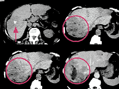 Abb. 4: Computertomografie bei Leberabsiedlungen einer Hormon ausschüttenden Darmgeschwulst. Abb. 4a (links oben): einzelne Verkalkungen (Pfeil) finden sich im Nativ- CT im rechten Leberlappen, Abb. 4b (rechts oben): ferner sind mehrere Areale unterschiedlich erniedrigter Dichte (eingekreist) sichtbar. Abb. 4c (links unten): Diese Areale erscheinen in der arteriellen Phase teilweise gut perfundiert und deshalb heller. Dunkel sind hingegen Geschwulstanteile mit fehlender Durchblutung. Abb. 4d (rechts unten): Zum Zeitpunkt der Pfortaderphase sind die Tumoranteile insgesamt weniger durchblutet als das Lebergewebe, daher dunkler als dieses dargestellt.