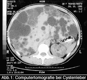 Computertomografie bei Cystenleber