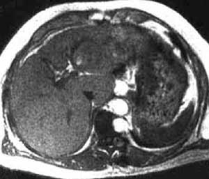 Abbildung 1: Magnet- Resonanz- Tomografie (MRT) eines HCC vor Kontrastmittelgabe.