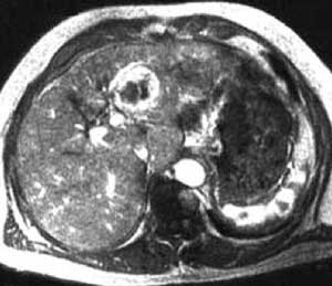 Abbildung 2: Magnet- Resonanz- Tomografie (MRT) eines HCC nach Kontrastmittelgabe.