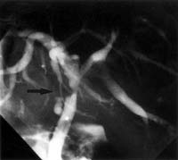 Abb. 5: Röntgenbild einer Gallengangstenose nach Lebertransplantation.