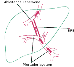 Schematische Darstellung eines TIPS. Die Pfeile zeigen die Flussrichtung des Blutes