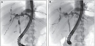 Abb.1: ERCP bei einem Patienten mit fortgeschrittener PSC. Die Gallenwege sind durch eine Stenose im Hauptgallengang (DHC) massiv erweitert (A) und weisen die PSC-typischen Kaliberunregelmäßigkeiten auf. In (B) wird die Stenose mit Hilfe eines Dilatationsballons erweitert.