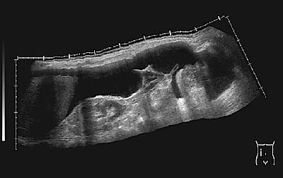 Ultraschall- Aufnahme in Seascape-Technik von der rechten Körperseite her. Oben die Bauchdecke, darunter Aszites (schwarz). Von links ragt schwach sichtbar die Leber ins Bild, umgeben von einem schwarzen Flüssigkeitssaum. Daneben die Rechte Niere. Auf d