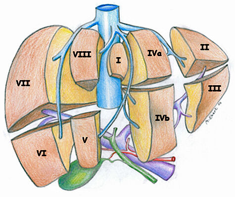 Abbildung 2: Schematische Darstellung der Lebersegmente nach Couinaud(6).Blau dargestellt sind die „untere Hohlvene“ (V.cava inferior) und die Lebervenen mit ihren Ästen. Pinkfarben dargestellt sind die Pfortader (V. portae) und ihre Äste. Rot dargestellt ist die Leberarterie (A. hepatis) mit Ästen. Grün dargestellt ist die Gallenblase und ein Teil der außerhalb der Leber gelegenen (extrahepatischen) Gallengänge.Die Abbildung verdanke ich Herrn Dr. M.Ebert, Institut für Radiologie und Neuroradiologie, Krankenhaus Barmherzige Brüder Regensburg (7). Abdruck mit freundlicher Genehmigung des Springer Medizin-Verlages aus: Melter,M. und Mitarbeiter. Die pädiatrische Lebertransplantation. Monatsschr Kinderheilkd 160, 343-357 (2012). (1).