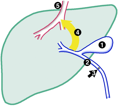 Gelbsucht: Die Galle wird durch die Gallenblase (1) und Gallengang (2) abgeleitet. Bei einer Abflusshinderung (3) staut sie sich. Bilirubin geht in das Blut über (4) und wird in den Körper transportiert (5).