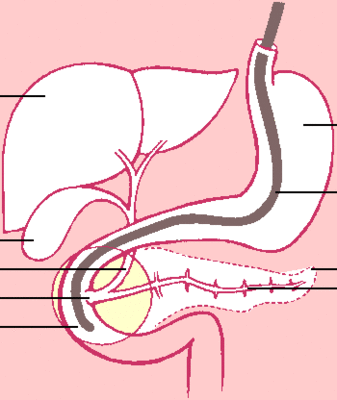 Schematische Darstellung Endoskopisch-retrograde Cholangio-Pankreaticographie