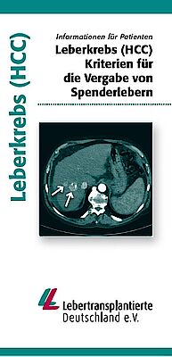 Leberkrebs (HCC) - Kriterien für die Vergabe von Spenderlebern