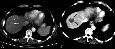 Abbildung 3: CT- Befunde Kontrastmittel aufnehmendes HCC im Segment 7/8 des rechten Leberlappens in der früharteriellen Phase vor Therapie (Pfeile). Nach RFTA jetzt nicht mehr Kontrastmittel aufnehmende Läsion in der früharteriellen Phase mit grössere