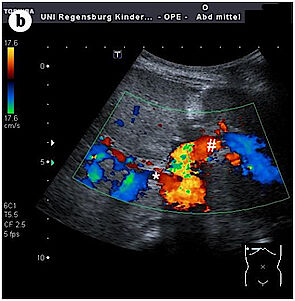 (b) Befund in der farbkodierten Dopplersonographie. EL, Eigenleber; SL, Spenderleber; *, Pfortaderast des rechten Patienteneigenleberlappens; #, Pfortaderast des linken Spenderleberlappen. Die Abbildung 3a verdanke ich Prof. Dr. H.J. Schlitt und PD Dr. M. Loss, Klinik und Poliklinik für Chirurgie, Universitätsklinikum Regensburg. Abdruck mit freundlicher Genehmigung des Springer Medizin-Verlages aus: Melter,M. und Mitarbeiter. Die pädiatrische Lebertransplantation. Monatsschr Kinderheilkd 160, 343-357 (2012). (1). 